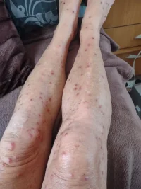 Bitten legs 2.jpg Bitten legs 2.jpg